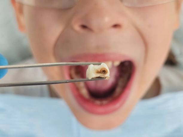 Best Emergency Dental Care for Broken or Chipped Teeth in Blackhawk, CA